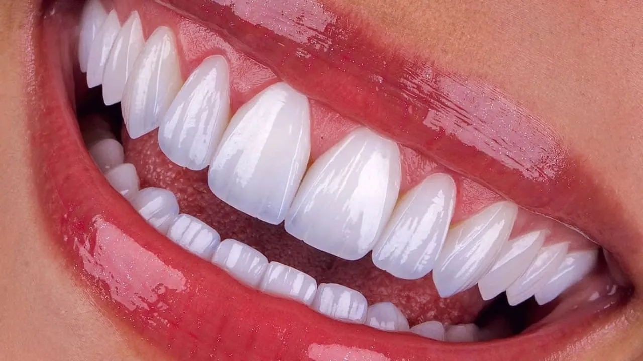 emax dental veneer