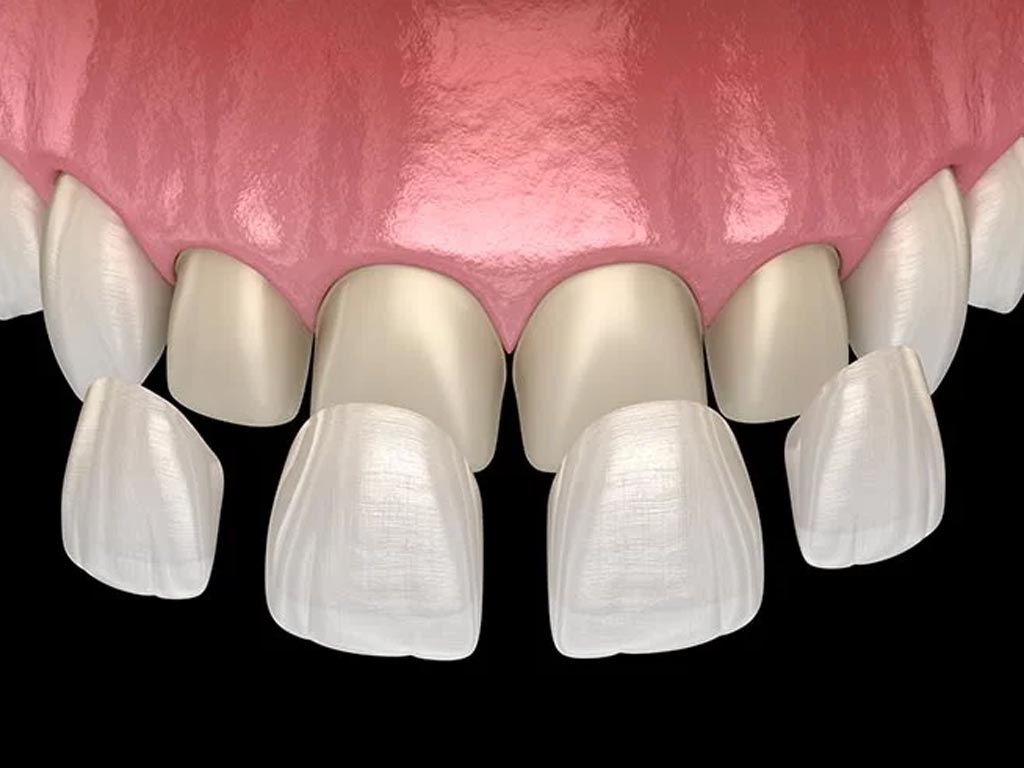 no prep laminate veneers in ankara