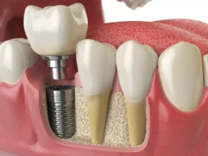 single-tooth implant